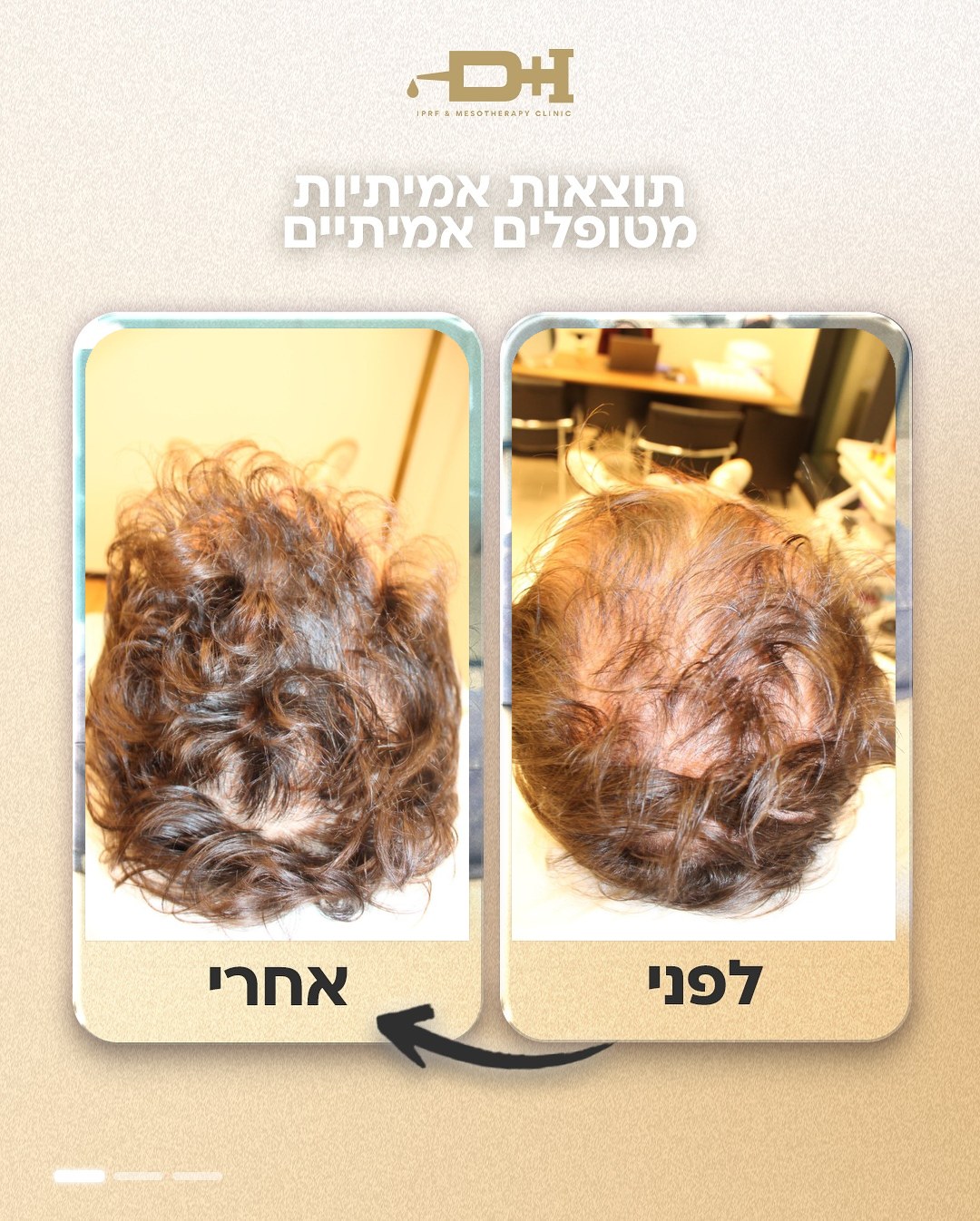 תוצאות לפני ואחרי טיפול IPRF