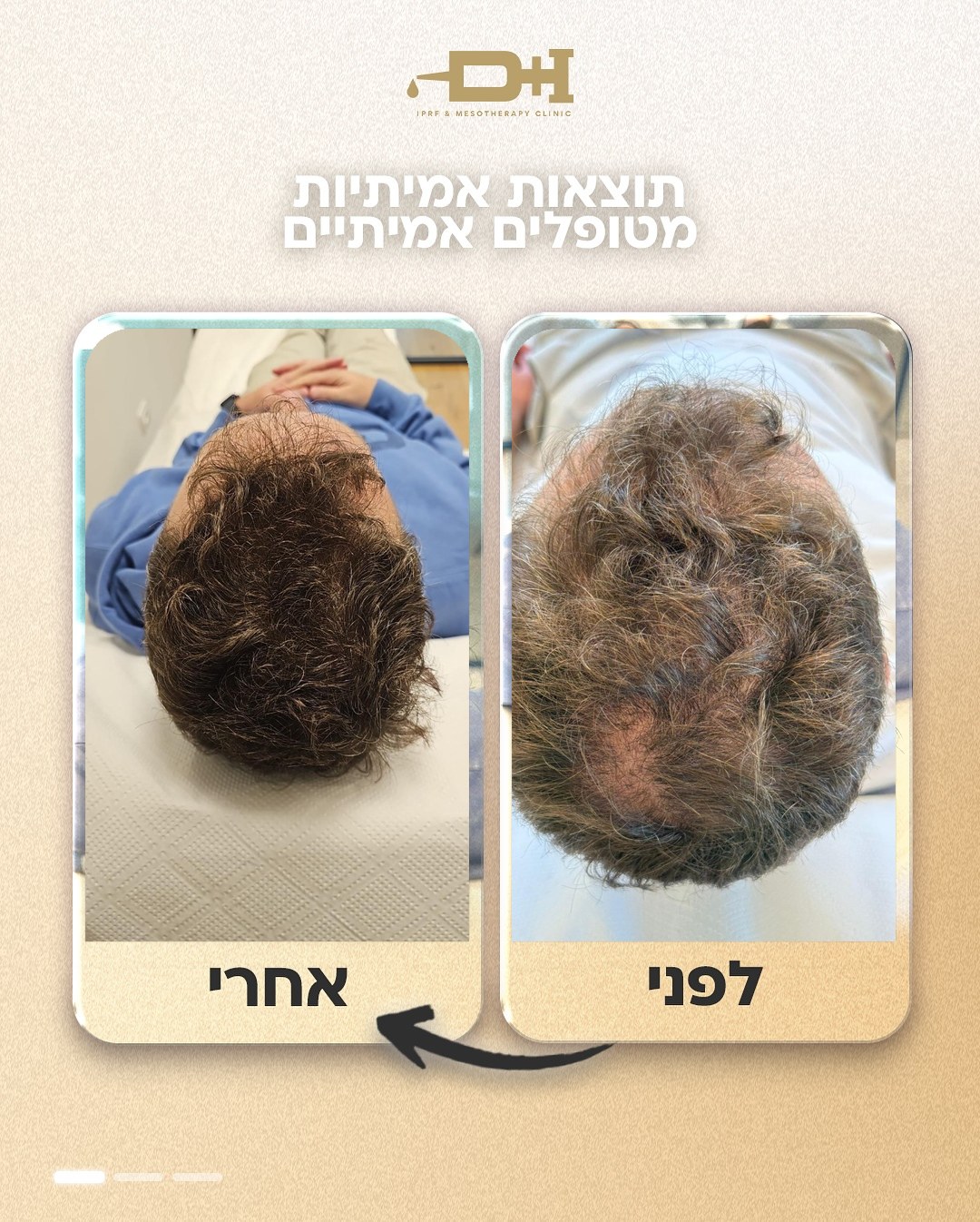 תוצאות לפני ואחרי טיפול IPRF