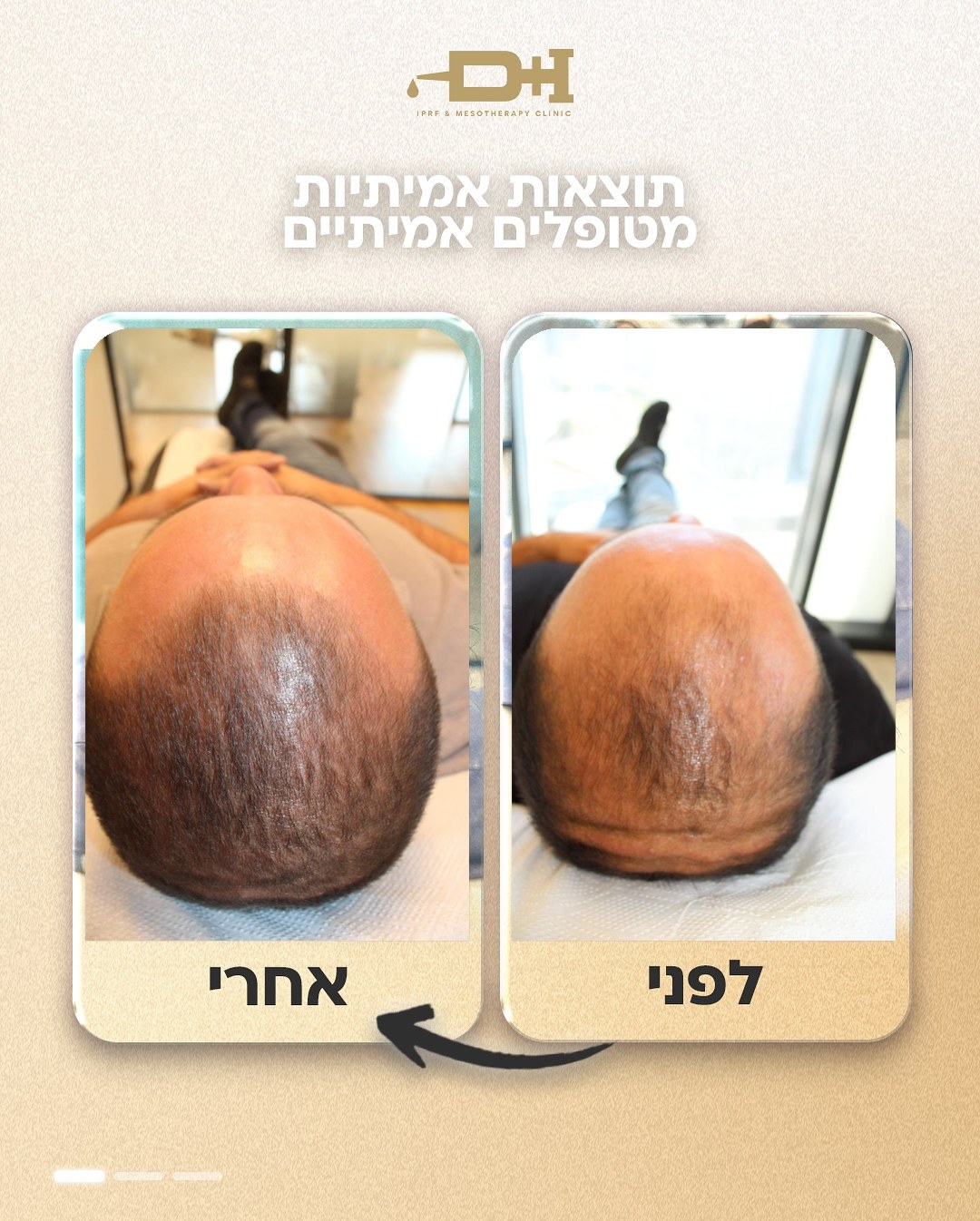 תוצאות לפני ואחרי טיפול IPRF