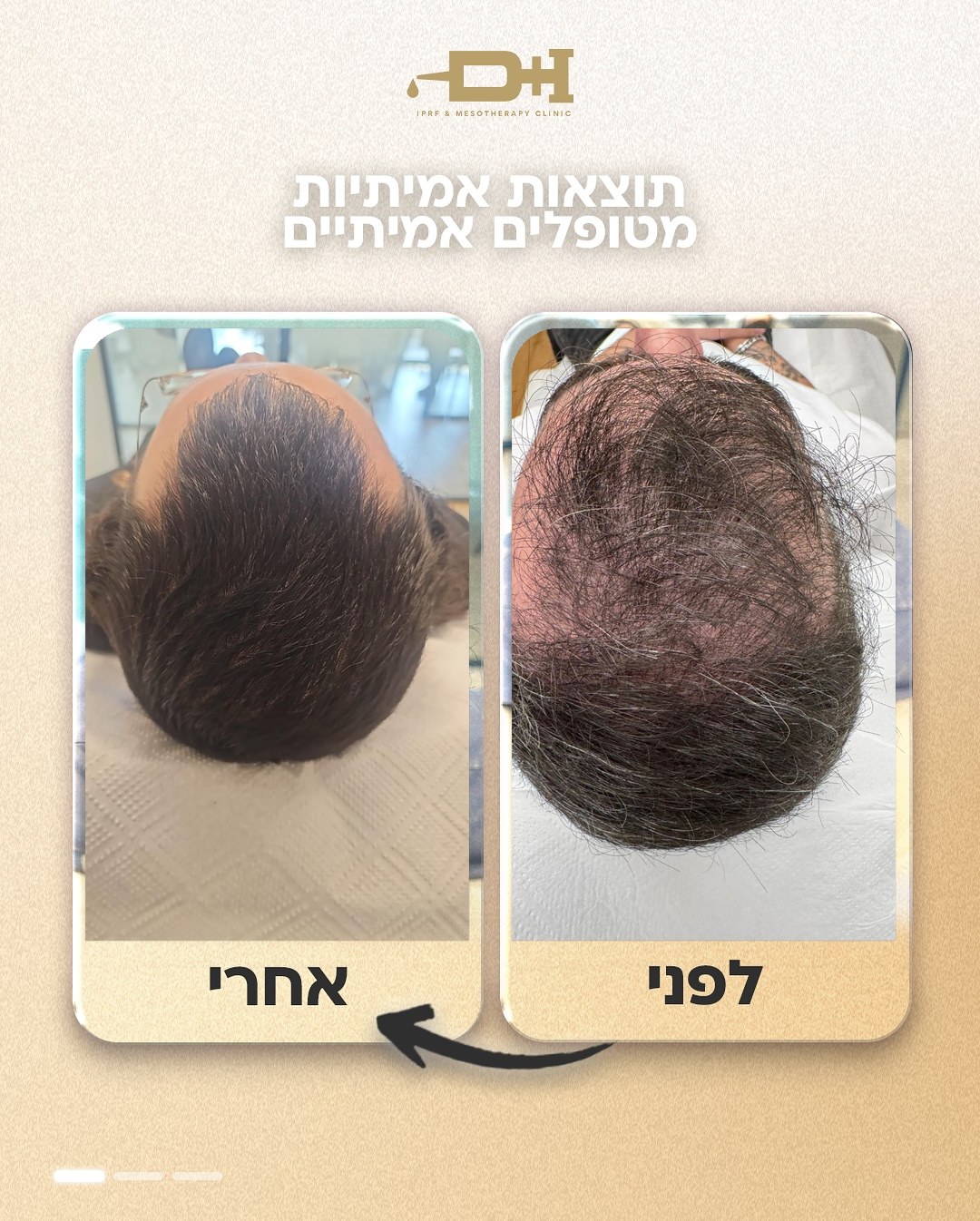 תוצאות לפני ואחרי טיפול IPRF
