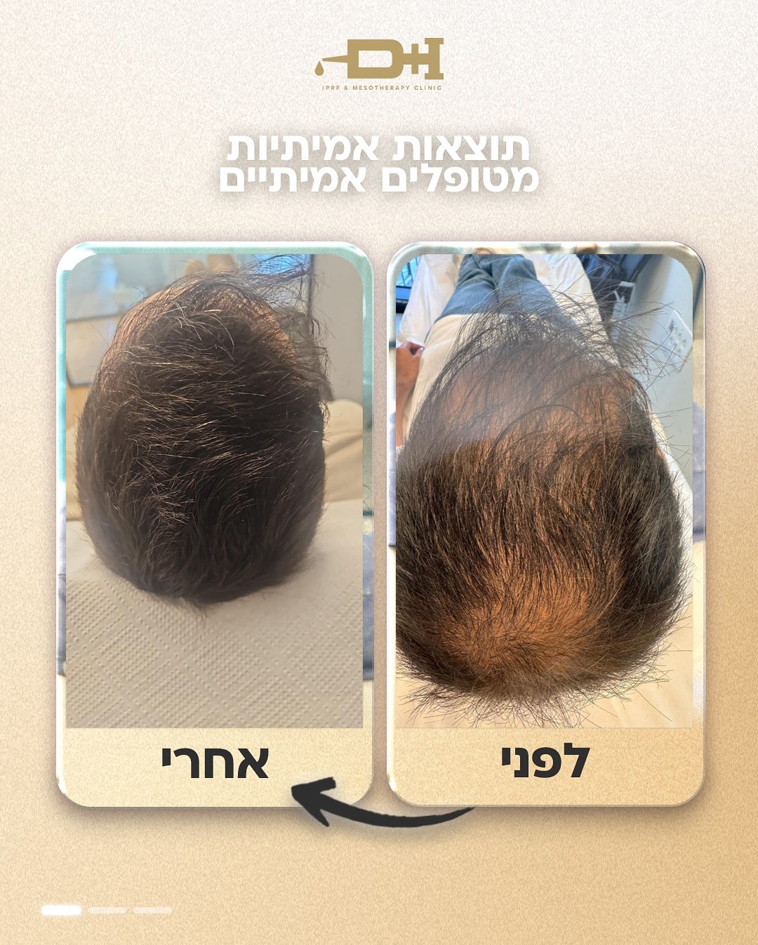 תוצאות לפני ואחרי טיפול IPRF