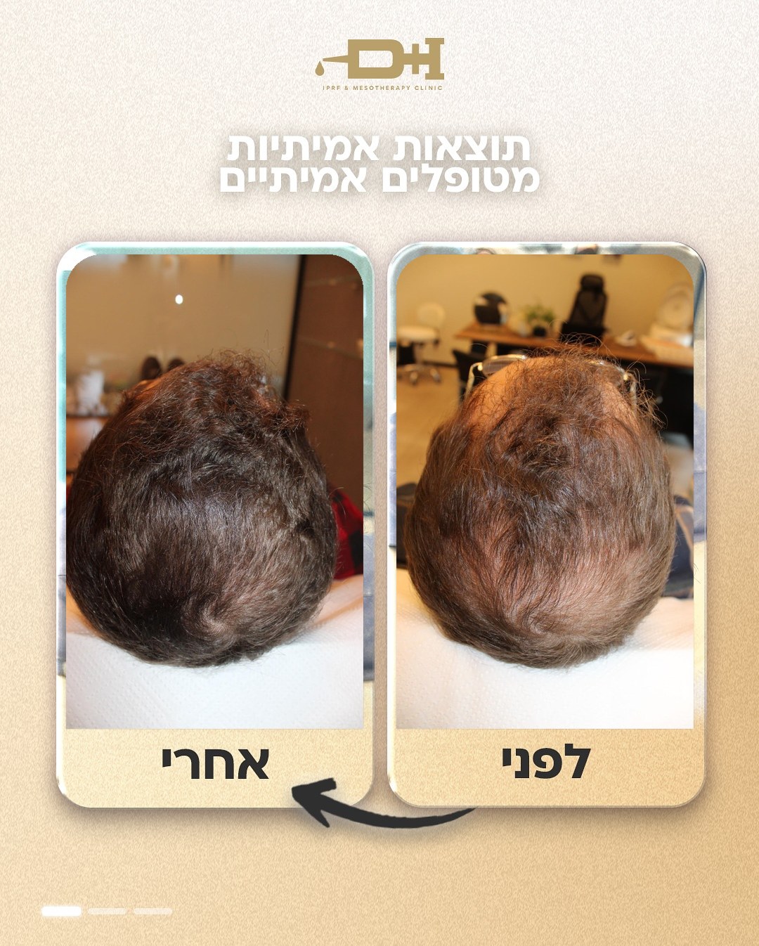 תוצאות לפני ואחרי טיפול IPRF